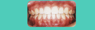 歯列育形成の症例