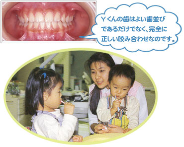 歯列育形成で小児矯正をした子供たち