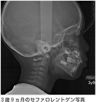 ３歳９ヵ月のセファロレントゲン写真