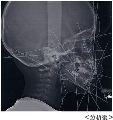 ３歳９ヵ月のセファロレントゲン写真 分析後