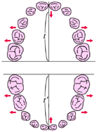 歯列育形成（育形）の手順１