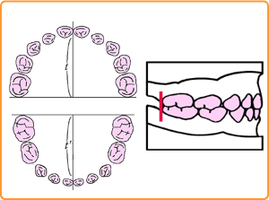 歯列育形成（育形）の手順