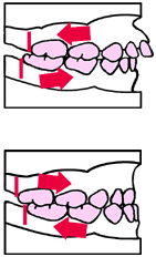歯列育形成（育形）の手順２