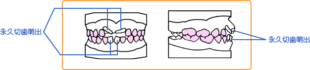 歯列育形成（育形）の手順
