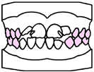 歯列育形成（育形）の手順３