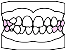 歯列育形成（育形）の手順３