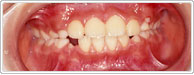歯列育形成継続中の写真