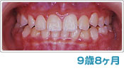 歯列育形成による反対咬合の経過 ９歳８ヶ月