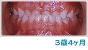 歯列育形成による反対咬合の経過 ３歳４ヶ月