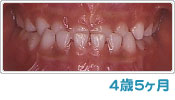 歯列育形成による反対咬合の経過 ４歳５ヶ月