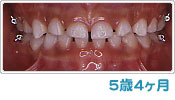 歯列育形成による反対咬合の経過 ５歳４ヶ月