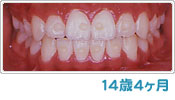歯列育形成による反対咬合の経過 １４歳４ヶ月