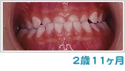 歯列育形成による反対咬合の経過 ２歳１１ヶ月
